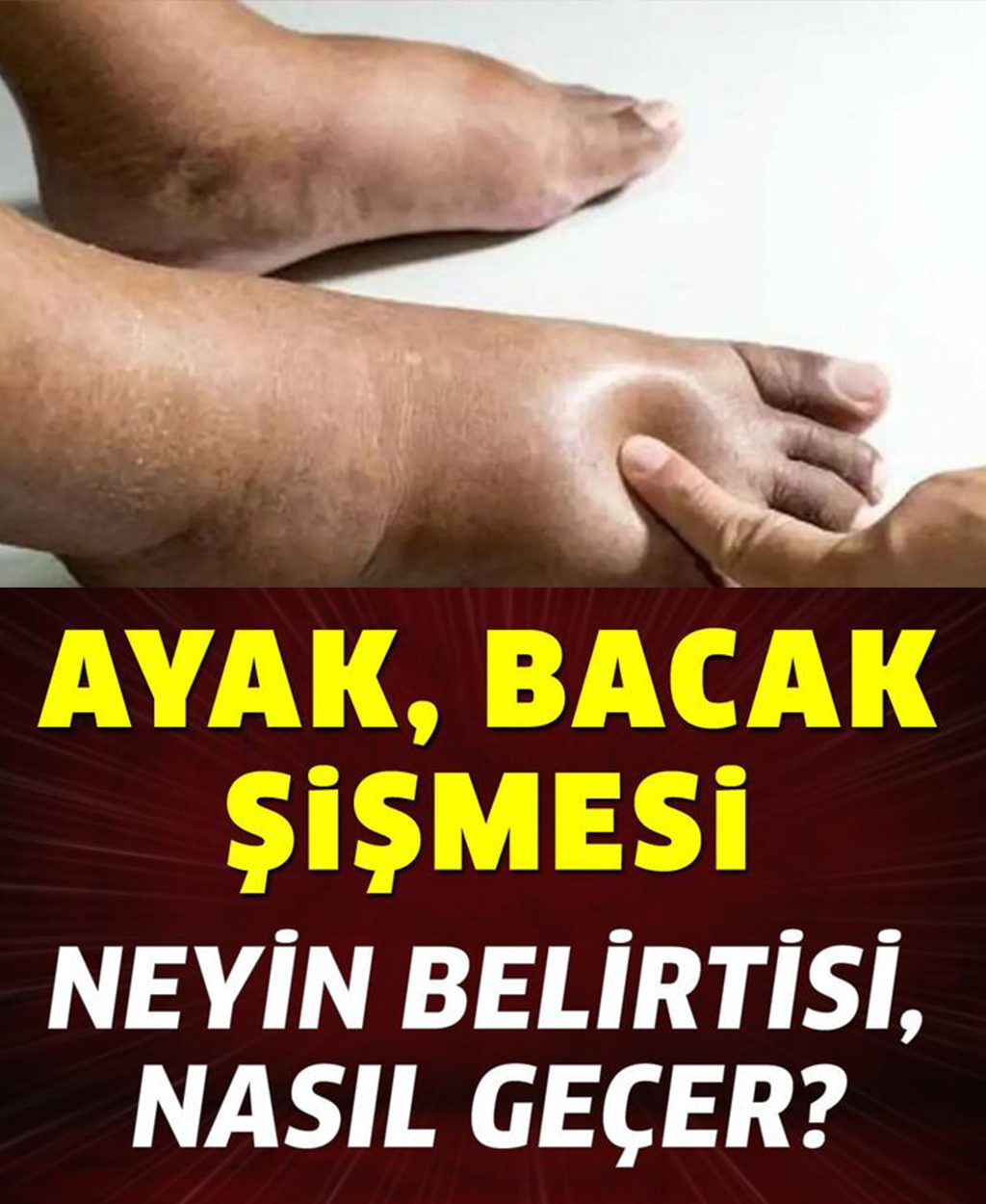 Ayak Bacak Şişmesi Neyin Belirtisi - 1