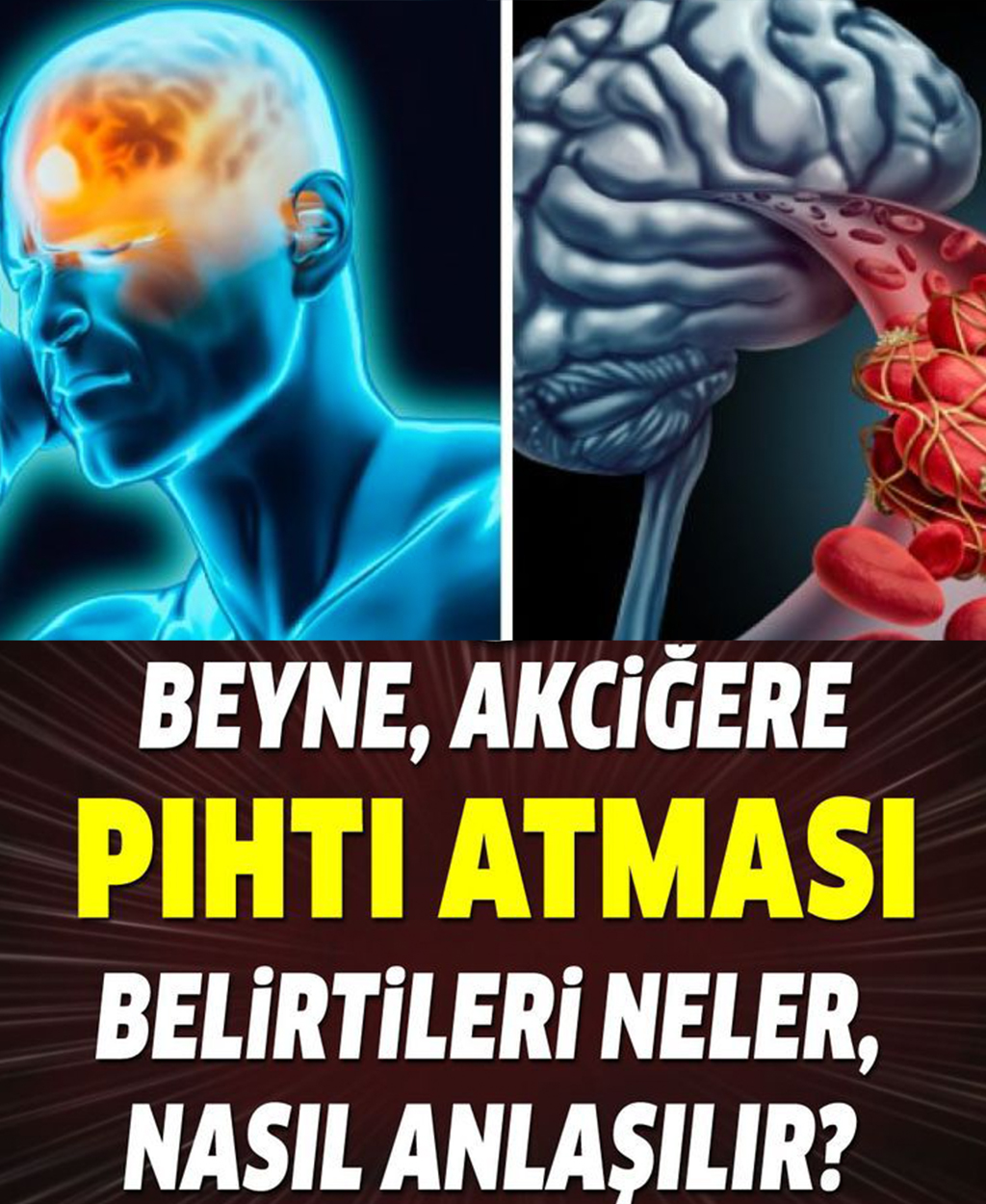 Pıhtı Atması Belirtileri Nelerdir - 1