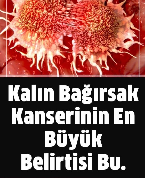 Kalın Bağırsak Kanserinin En Büyük Bulgusu - 1