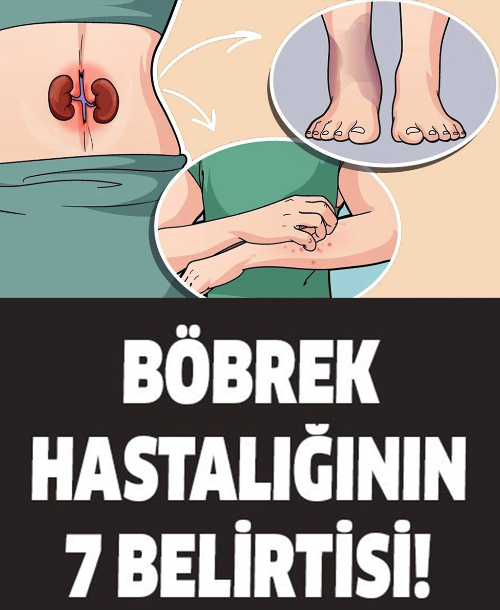 Böbrek Hastalığının 7 Belirtisi - 1