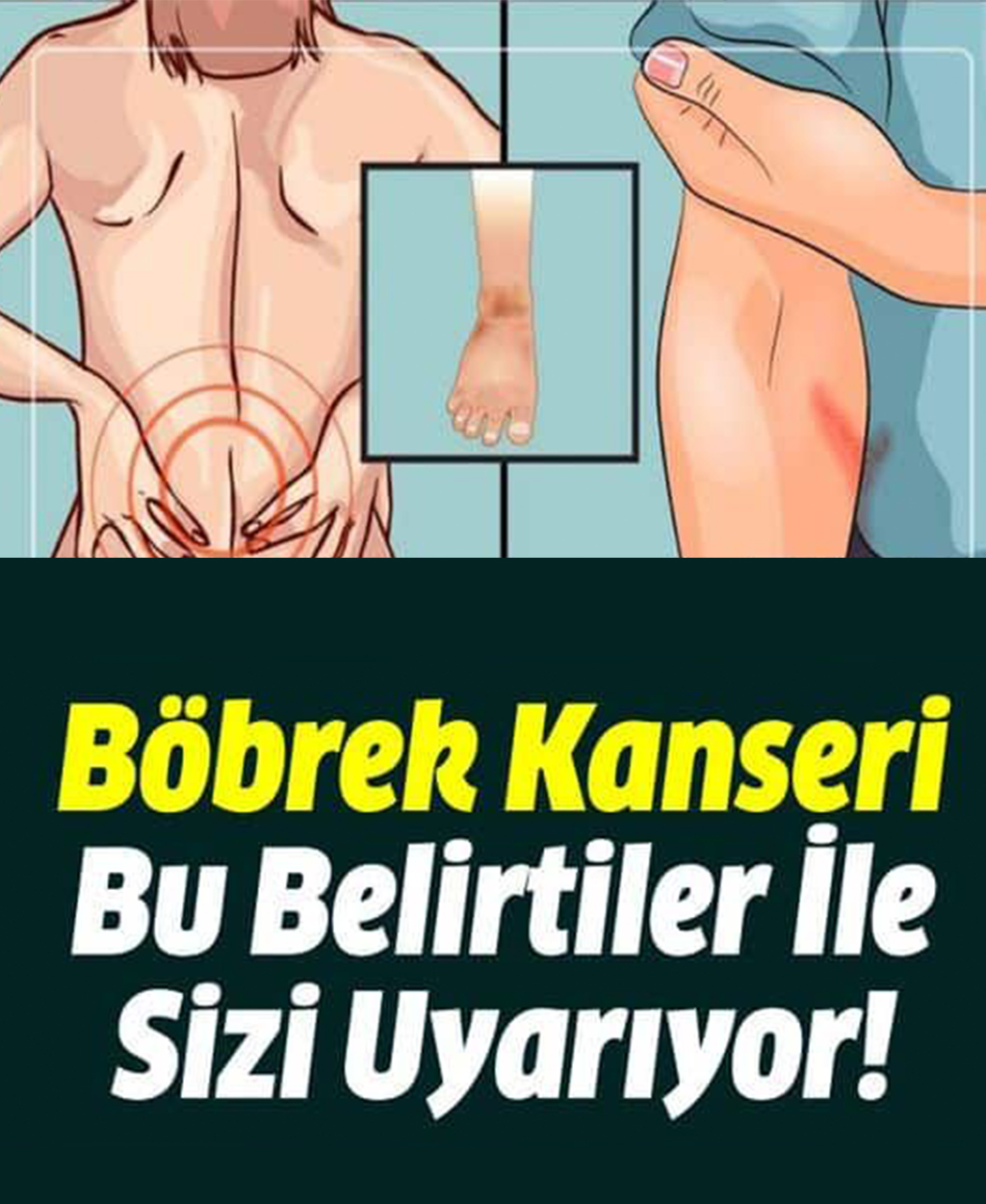 Böbrek Kanseri Bu Belirtiler İle Sizi Uyarıyor - 1