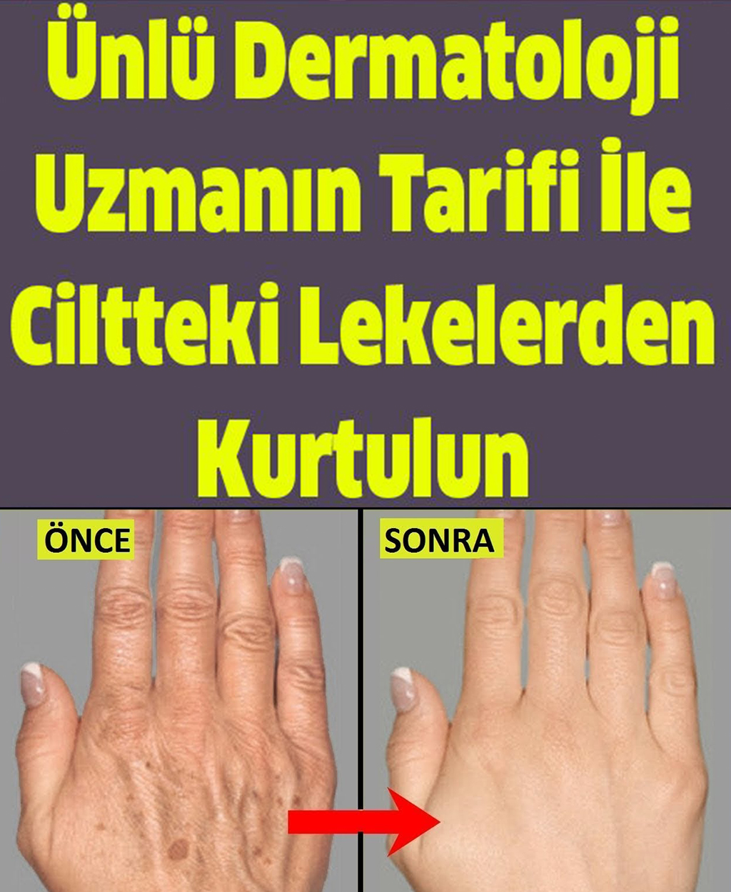 Ünlü Dermatoloji Uzmanın Tarifi İle Ciltteki Lekelerden Kurtulun - 1