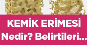 Kemik erimesi nedir belirtileri nelerdir?