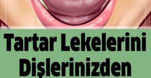 Tartar Lekelerini Dişlerinizden Çıkarmanın 10 Yolu