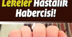 Tırnağınızdaki O Lekeler Hangi Hastalığın Habercisi