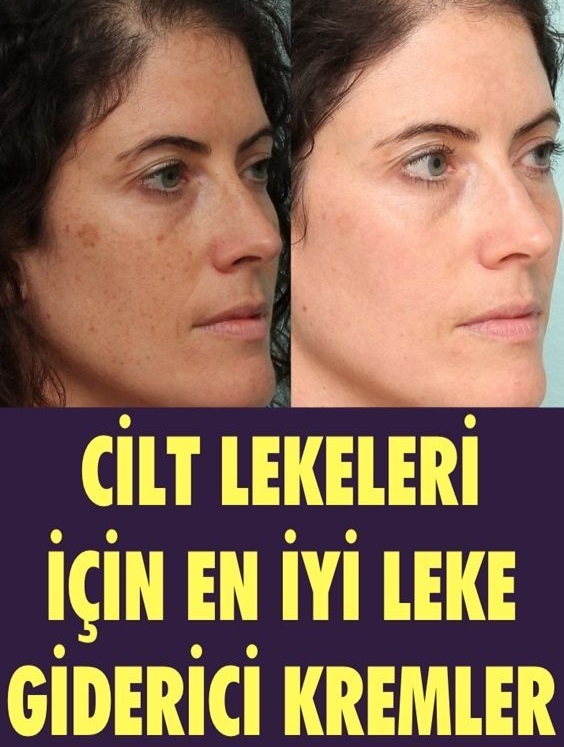 Cilt Lekeleri için En İyi Leke Giderici Kremler  - 1