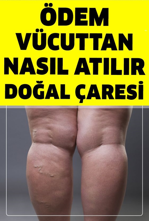 Vücudunuzdaki Birikmiş Ödemi Atmanın Doğal Çaresi - 1