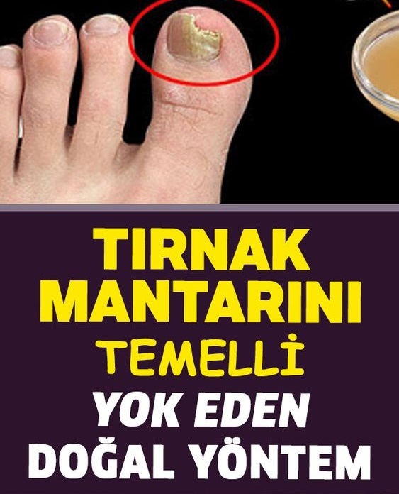 Tırnak Mantarını Temelli Yok Eden Doğal Yöntem - 1