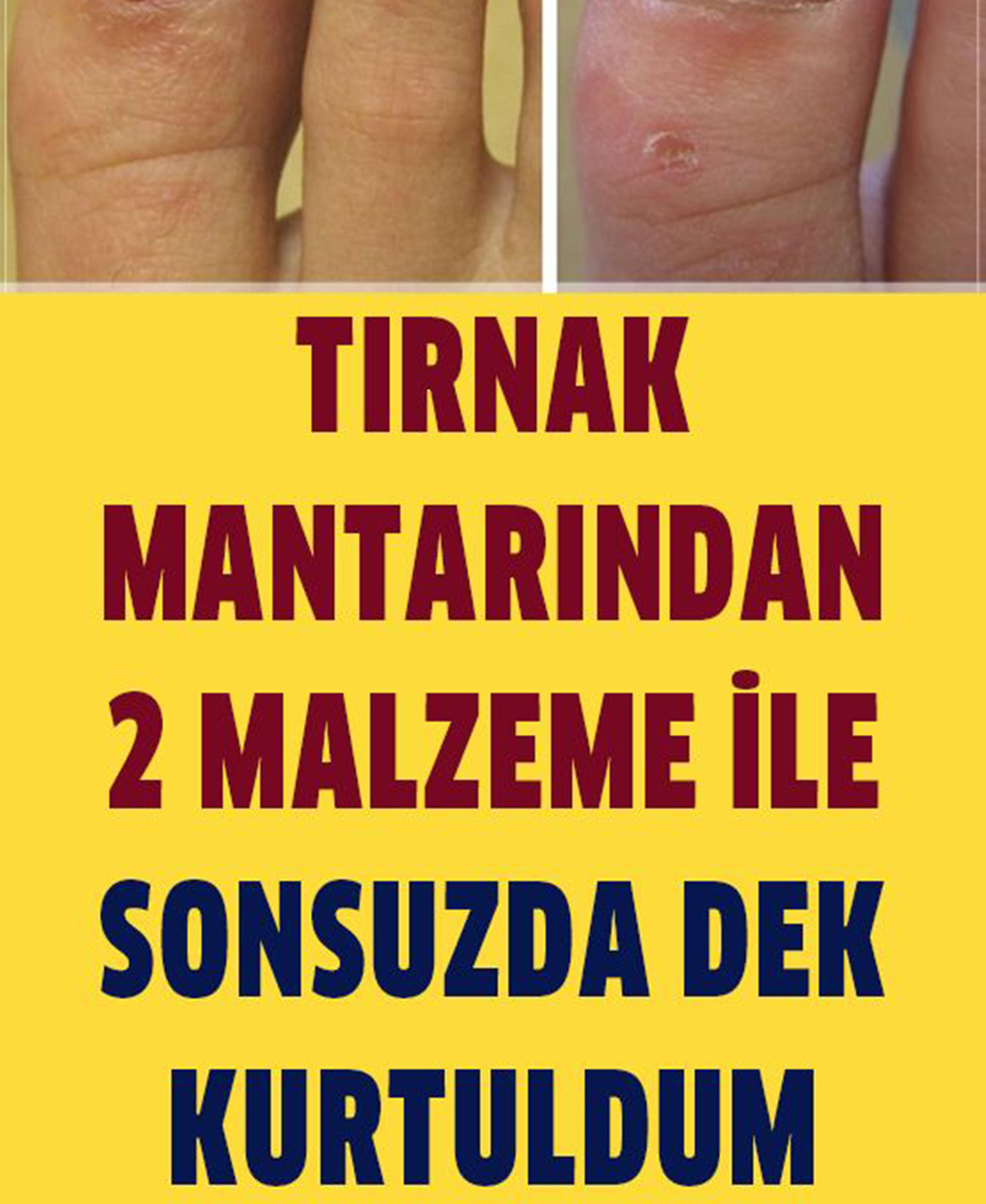 Sonsuza Dek Tırnak Mantarından Kurtulun 2 Malzemeli Tarif - 1