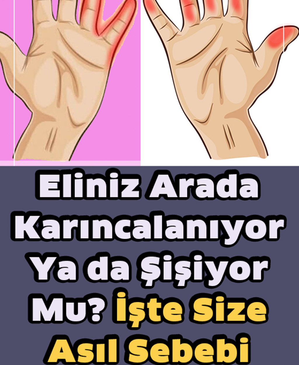 Elleriniz Arada Karıncalanıyor Ya Da Şişiyor Mu? - 1