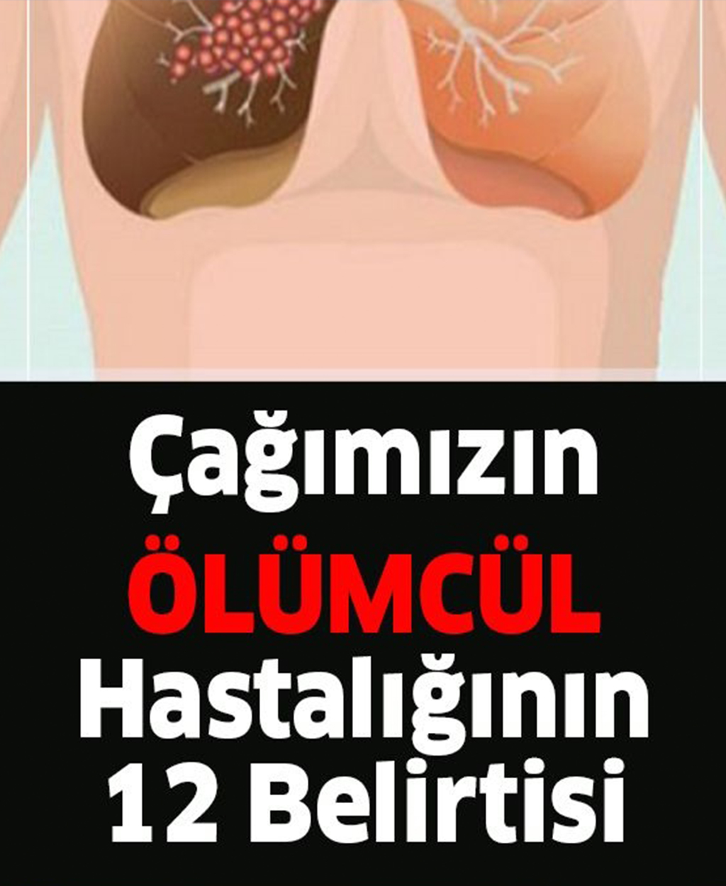 Çağın Hastalığı Akciğer Kanserinin Belirtileri - 1