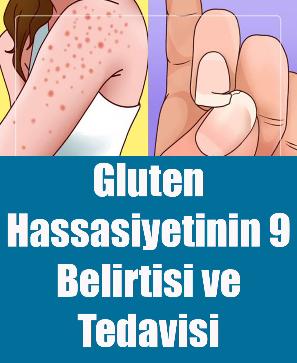 Gluten Hassasiyetinin 9 Belirtisi ve Tedavisi - 1