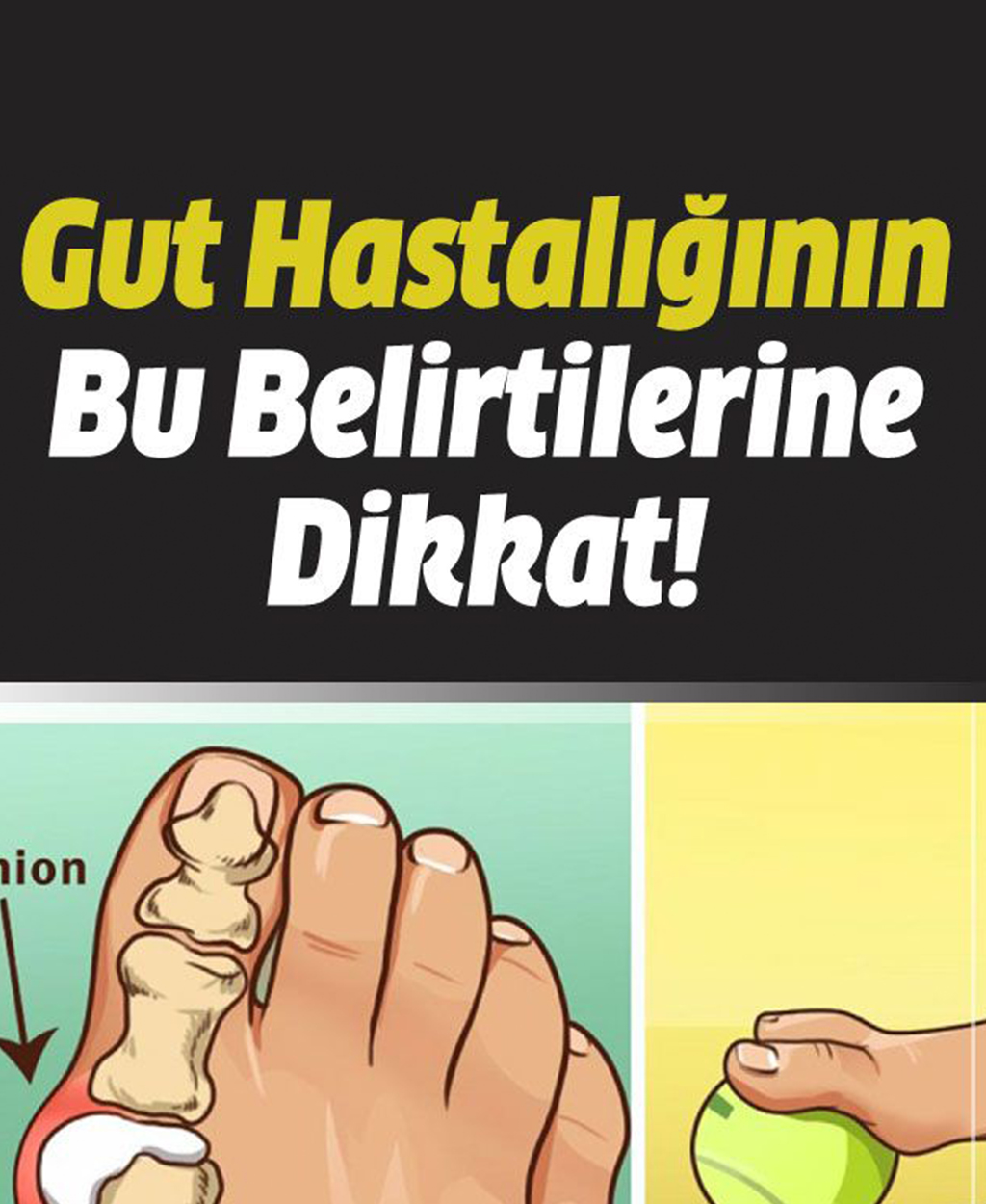 Gut Hastalığının Belirtilerine Dikkat - 1