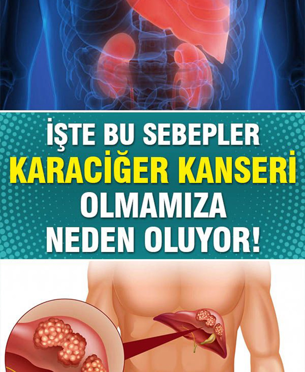 Bu Sebeplere Dikkat Karaciğer Kanseri Olmanıza Neden Oluyor - 1