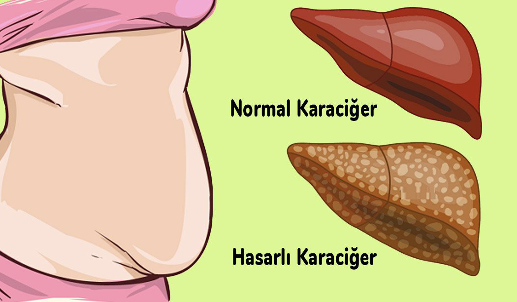 Karaciğerinizin Toksinlerle Dolu Olduğunun 6 Belirtisi - 3