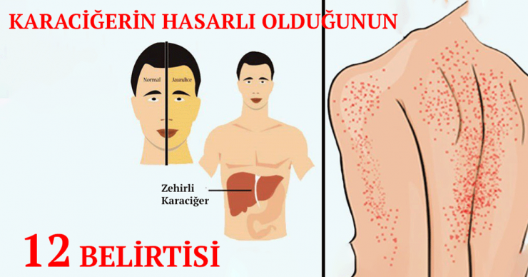 Karaciğerin Çalışmadığına Gösteren 10 Belirti - 2