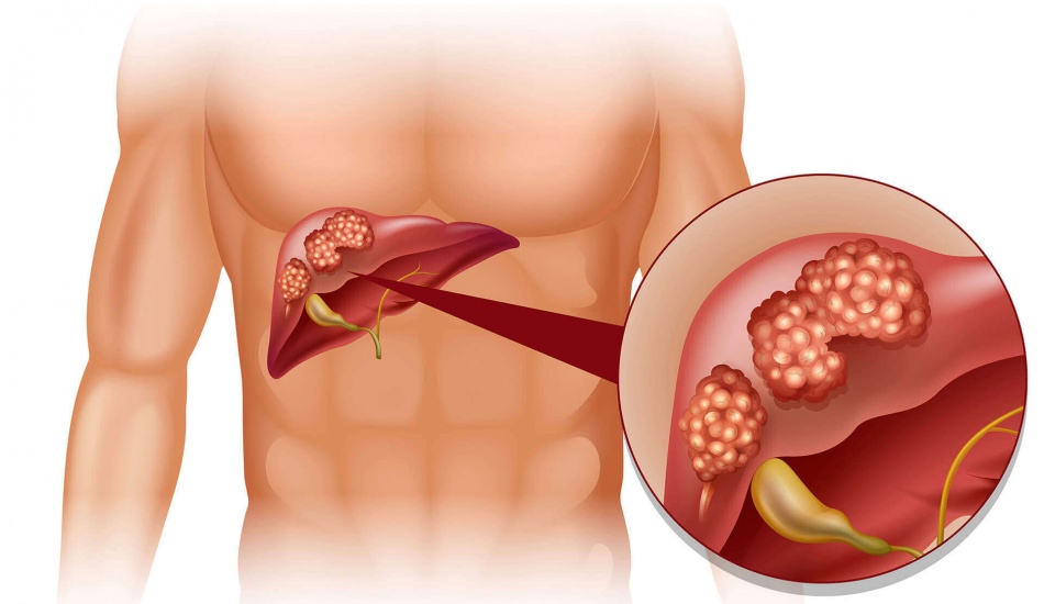 Bu Sebeplere Dikkat Karaciğer Kanseri Olmanıza Neden Oluyor - 2