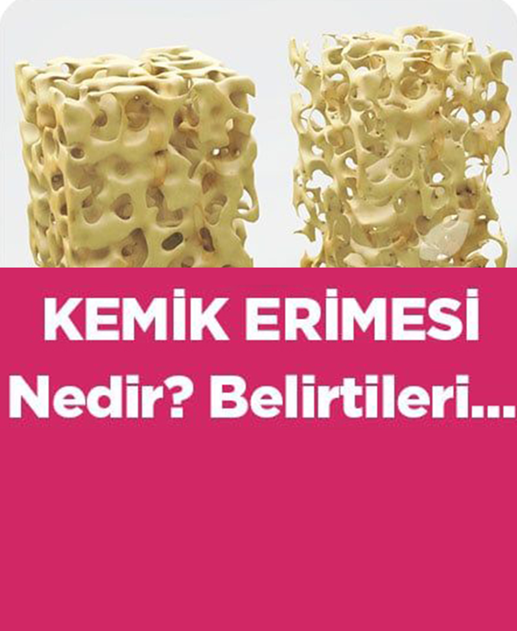 Kemik erimesi nedir belirtileri nelerdir? - 1