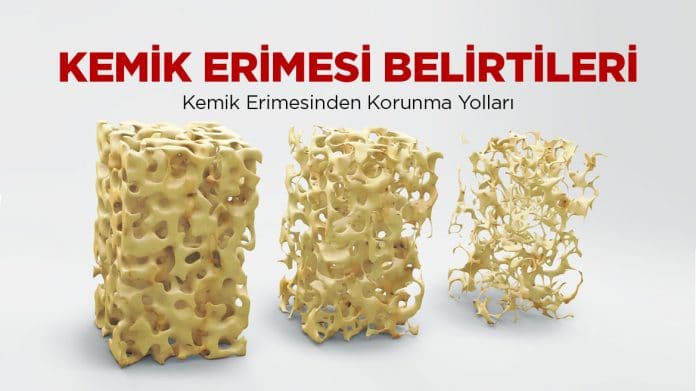 Kemik erimesi nedir belirtileri nelerdir? - 3