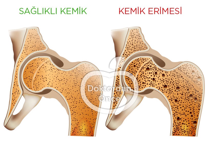 Kemik erimesi nedir belirtileri nelerdir? - 5