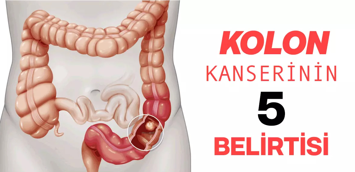 Kolon Kanserinin 5 Belirtisi - 2