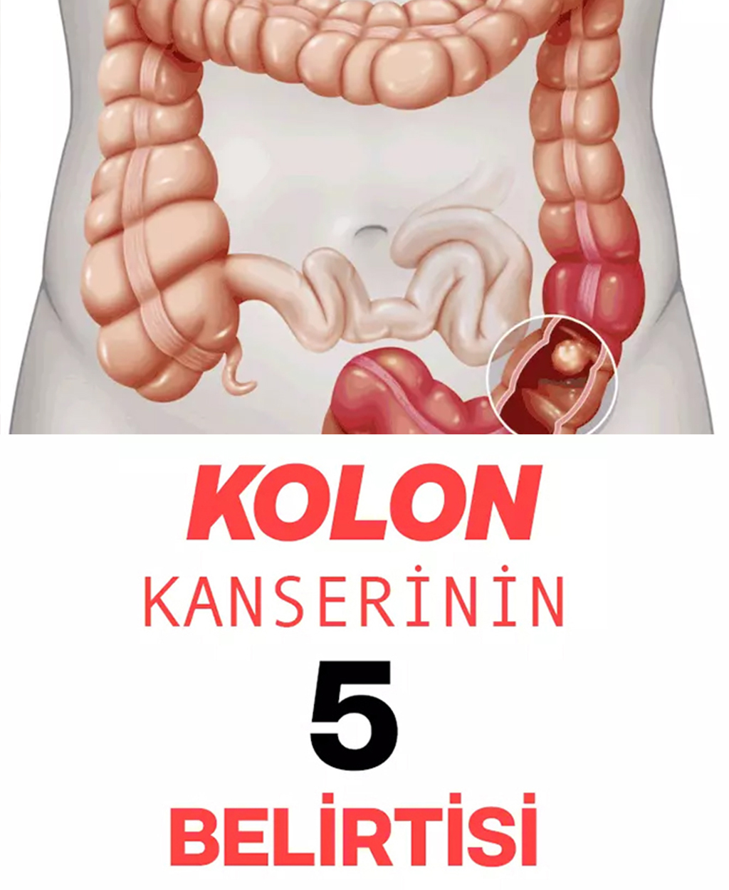 Kolon Kanserinin 5 Belirtisi - 1