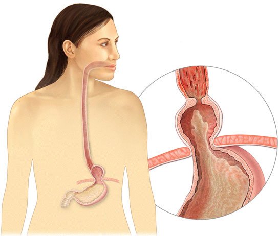 Gastrit ve Mide Sorunlarından Sonsuza Dek Kurtulun - 3