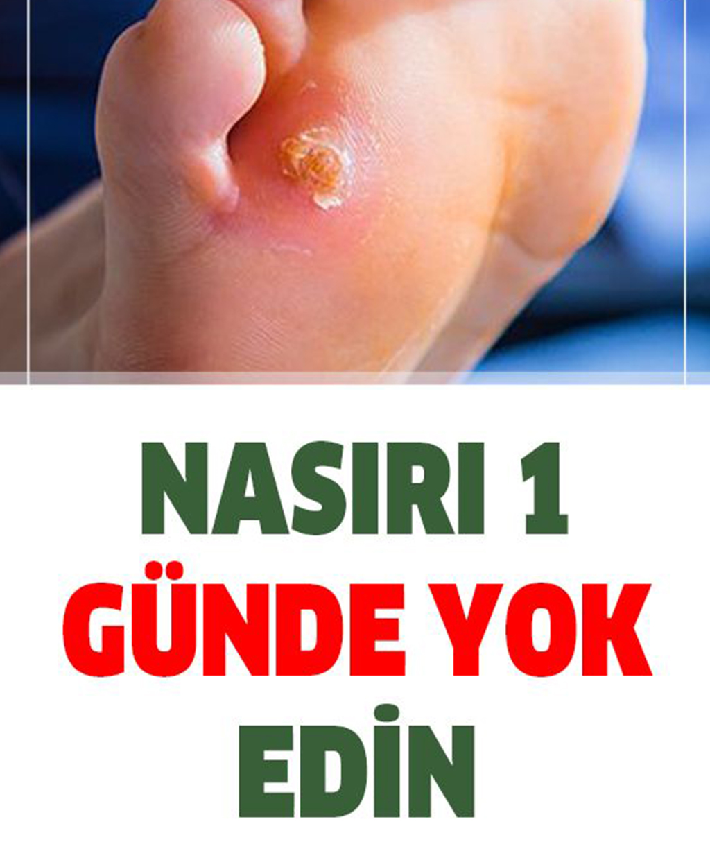 İşte Nasırdan 1 Günde Kurtaracak Doğal Tedavi Yöntemleri - 1