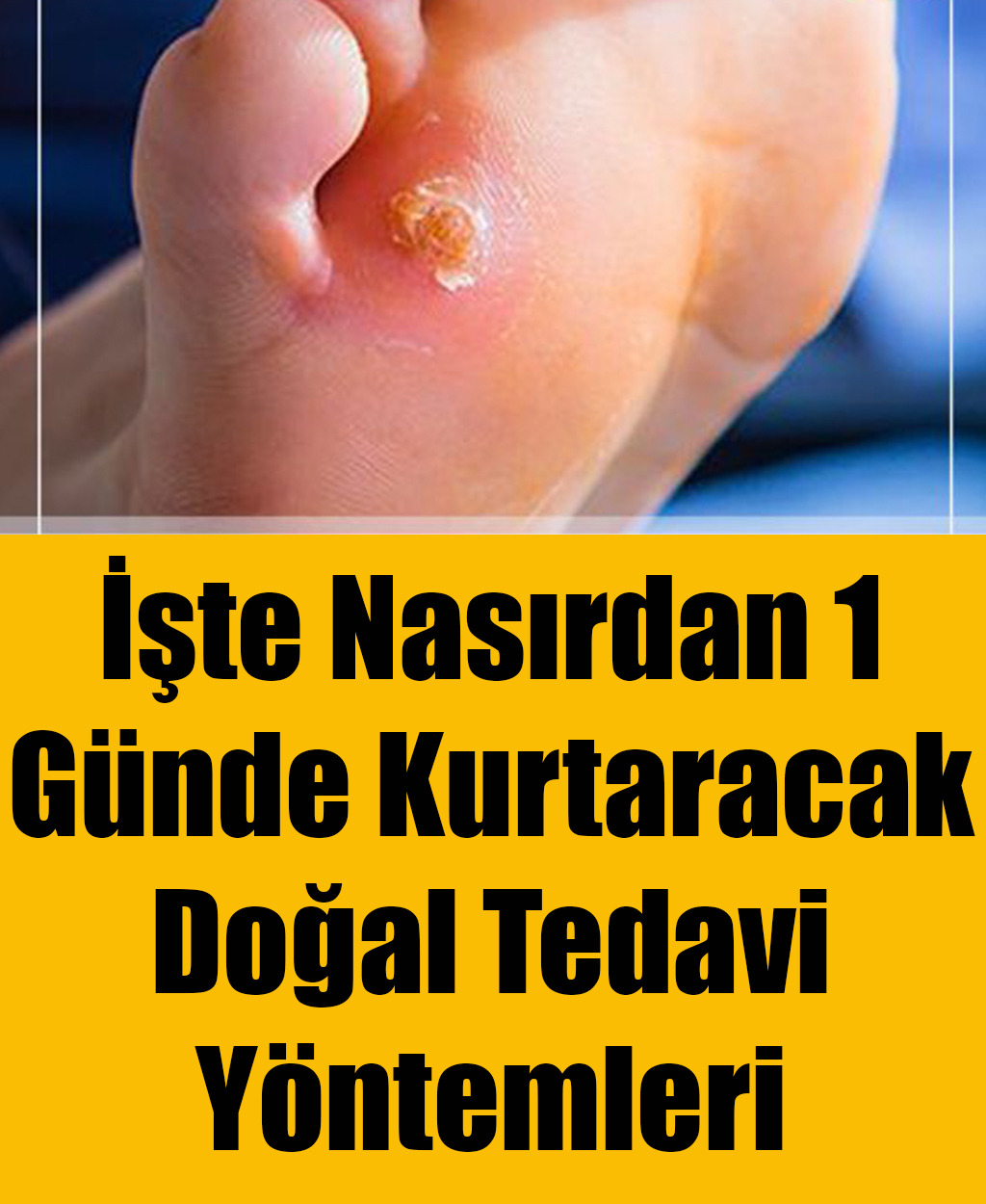 İşte Nasırdan 1 Günde Kurtaracak Doğal Tedavi Yöntemleri - 1