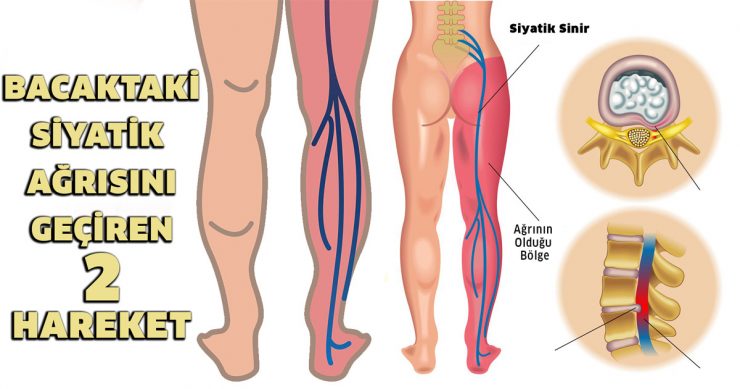 Siyatik Ağrısını Geçiren 2 Hareket - 2