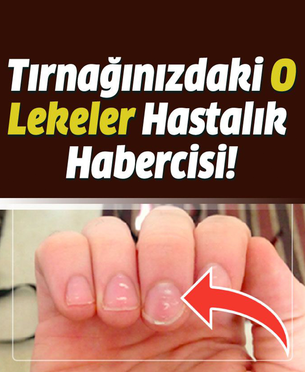 Tırnağınızdaki O Lekeler Hangi Hastalığın Habercisi - 1