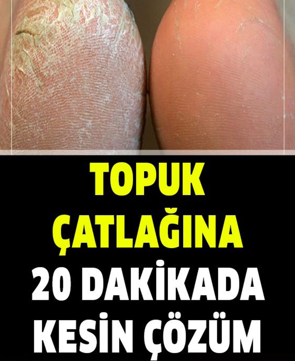 Topuk Çatlağına 20 Dakikada Son - 1