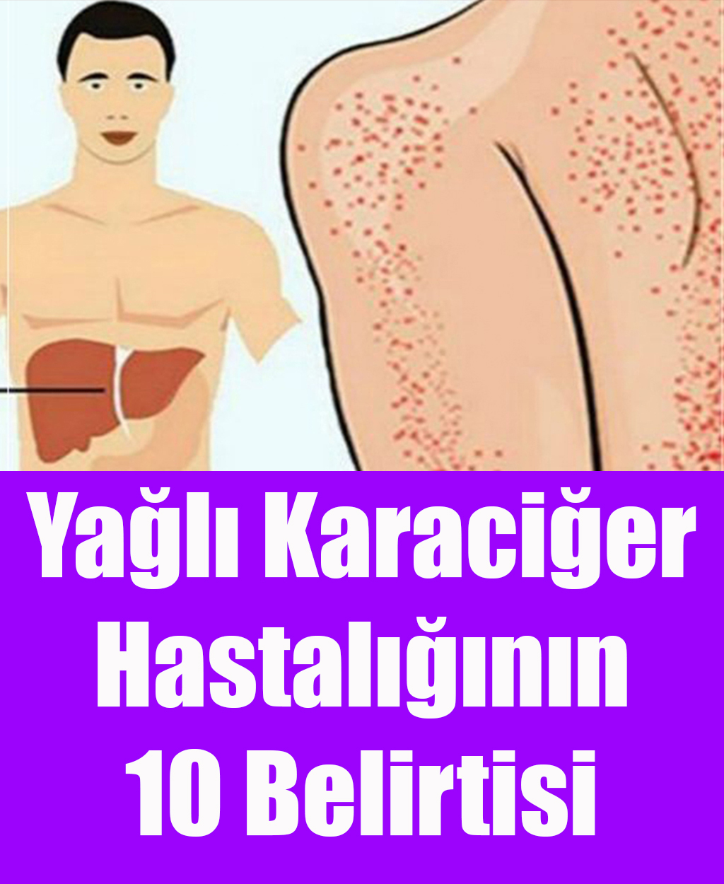 Yağlı Karaciğer Hastalığının 10 Belirtisi - 1